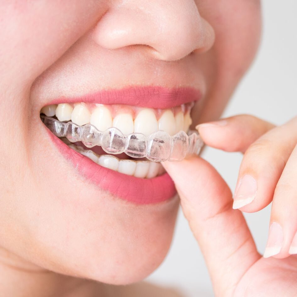 Invisalign trays at village dental when you receive cosmetic services.